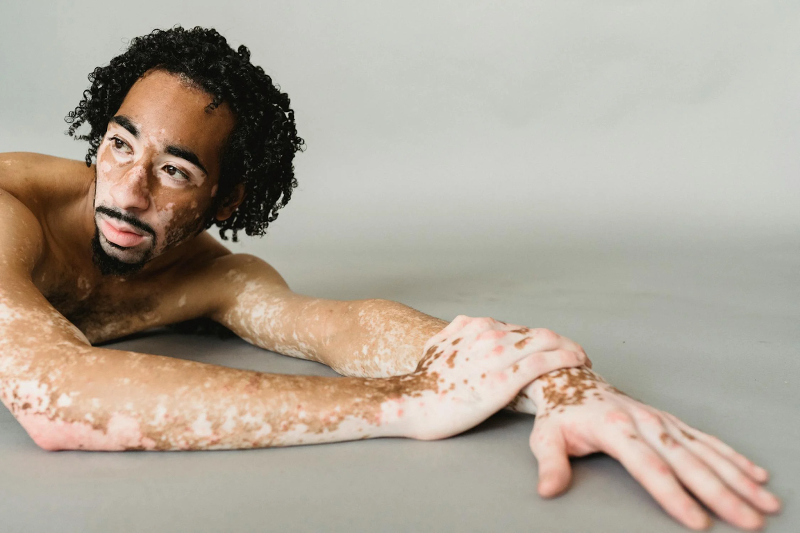 Man with vitiligo looking for a treatment.